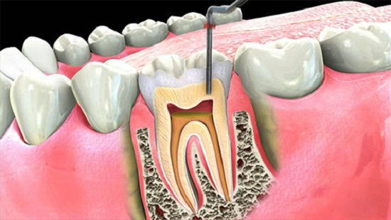 Root canal treatment in ludhiana